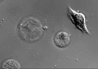 Grayscale microscopic image of dying melanoma cells